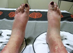 Gaelyn's swollen feet Pretoria South Africa